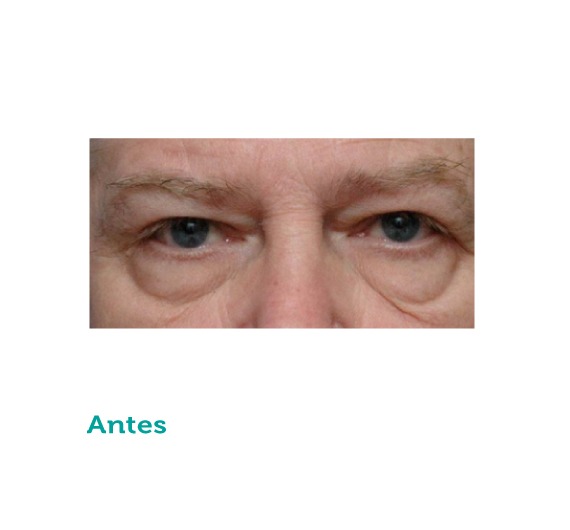 Cirugía maxilofacial - clínica estética - clínica paramo - parpados - cirugia de parpados- viviana paramo- Bogota Colombia - ojos - corrección