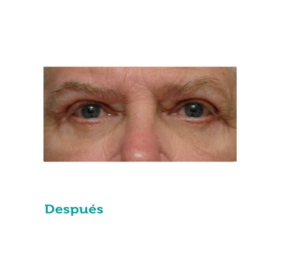 Cirugía maxilofacial - clínica estética - clínica paramo - parpados - cirugia de parpados - viviana paramo- Bogota Colombia - ojos - corrección