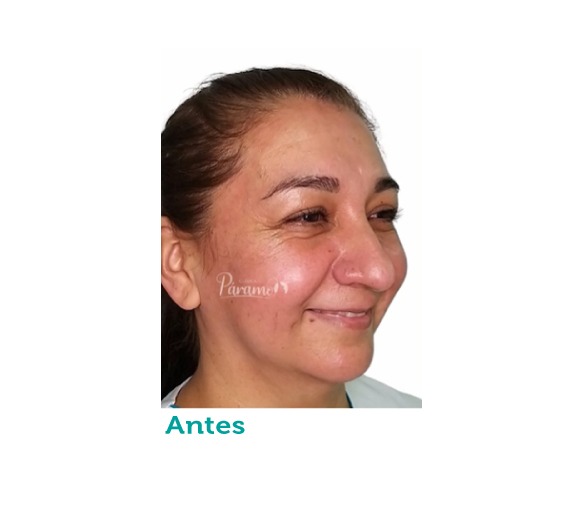 Cirugía maxilofacial - clínica estética - clínica paramo - parpados - cirugia de parpados- - viviana paramo- Bogota Colombia - arrugas- lineas de expresion - corrección
