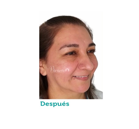 Cirugía maxilofacial - clínica estética - clínica paramo - parpados - cirugia de parpados- viviana paramo- Bogota Colombia - arrugas- lineas de expresion - corrección