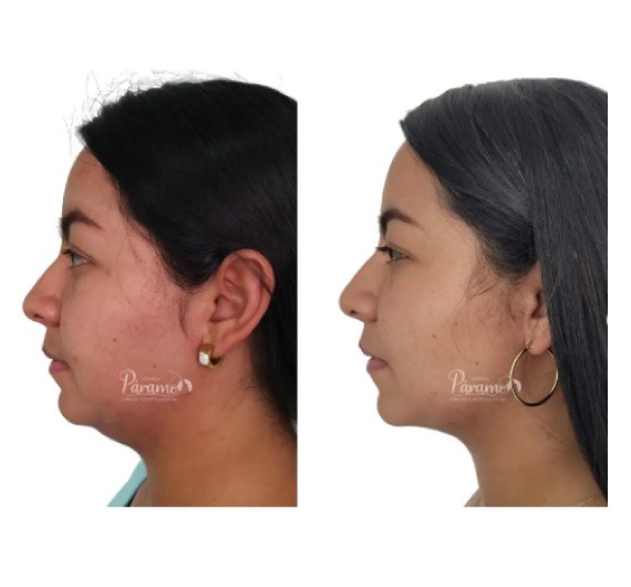 Cirugía maxilofacial - clínica estética – clínica paramo - lipopapada - Bogota Colombia - cuello