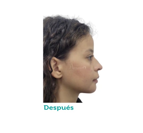 Cirugía maxilofacial - clínica estética - clínica paramo - mentoplastia - viviana paramo- Bogota Colombia - mentón - corrección - armonía del rostro