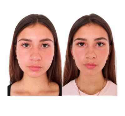 Cirugía maxilofacial - clínica estética - clínica paramo - bichectomia - Bogota Colombia - cachetes - estiliza el rostro - armonía facial