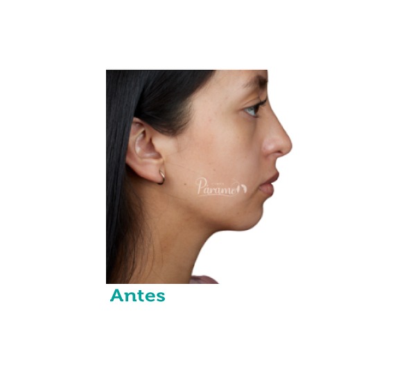 clínica estética - clínica paramo - relleno - labios- ojeras- rinomodelacion- surcos - Bogota Colombia