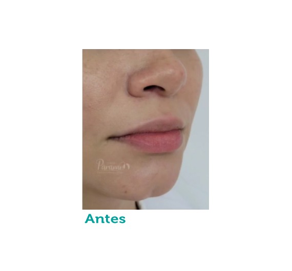 clínica estética - clínica paramo - relleno - labios- ojeras- rinomodelacion - surcos - Bogota Colombia