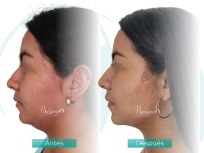 lipopapada-en-clinica-paramo