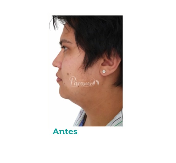 Cirugía maxilofacial - cuello -clínica estética - clínica paramo - lipopapada - Bogota Colombia