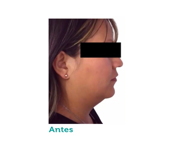 Cirugía maxilofacial - cuello -clínica estética - clínica paramo - lipopapada - Bogota Colombia