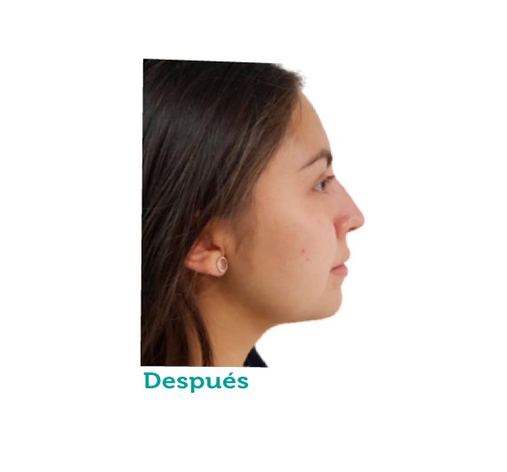 Cirugía maxilofacial - clínica estética - clínica paramo - mentoplastia - viviana paramo- Bogota Colombia - mentón - corrección - armonía del rostro