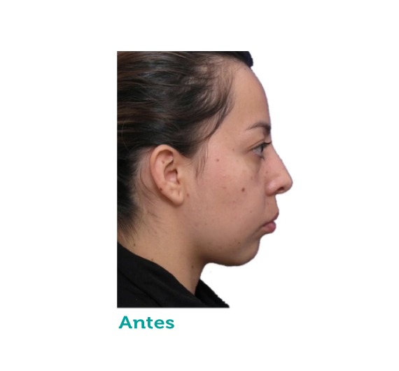Cirugía maxilofacial - clínica estética – mandíbula- maxilar- mentón - clínica paramo - cirugía ortognatica - Bogota Colombia