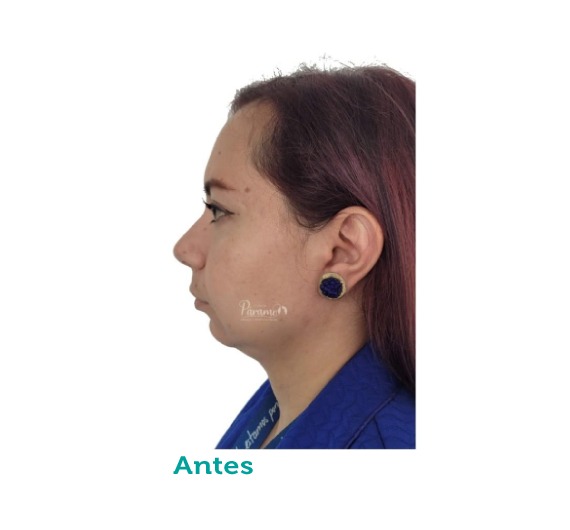 Cirugía maxilofacial - clínica estética – mandíbula- maxilar- mentón - clínica paramo - cirugía ortognatica - Bogota Colombia