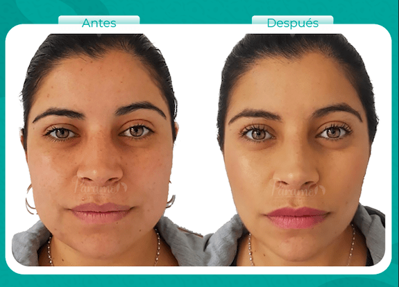 ¿Cómo sé que debo y puedo hacerme una Bichectomia?