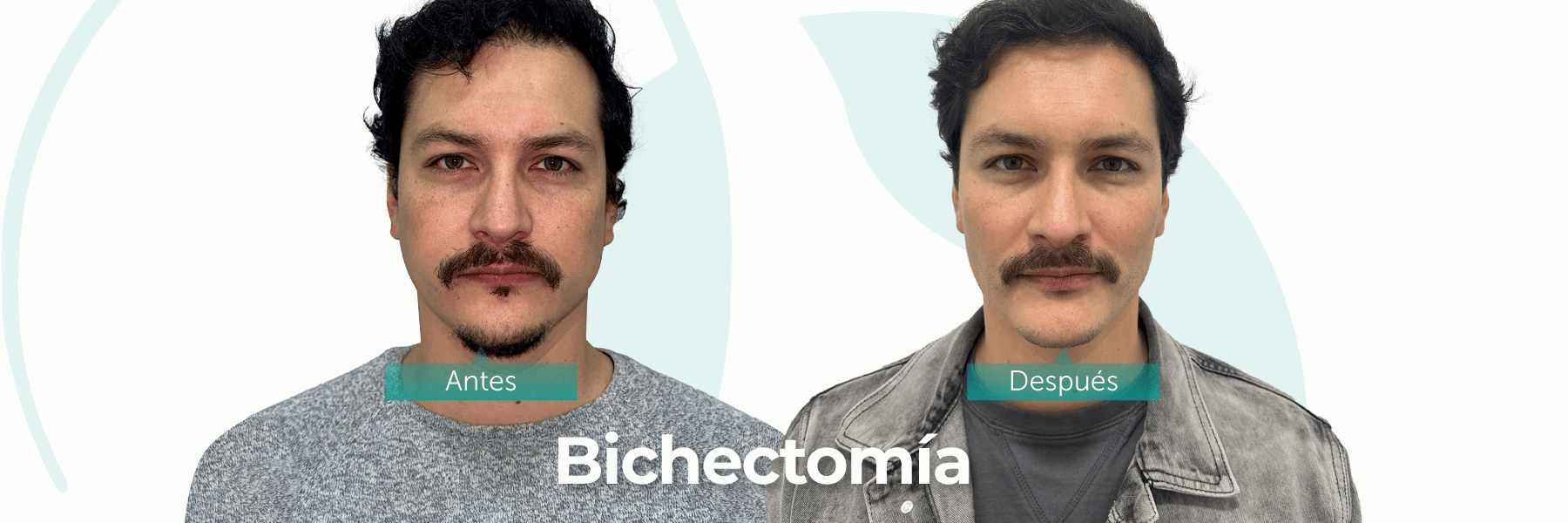 bichectomia-antes-y-despues