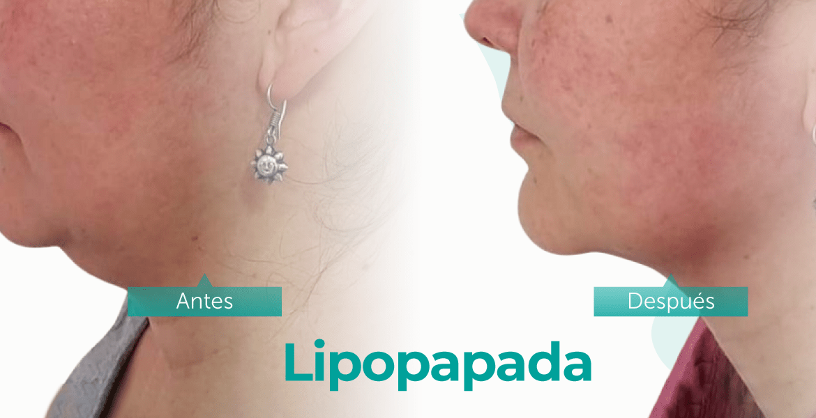 Beneficios de lipopapada