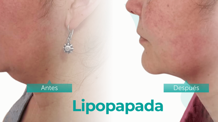 Beneficios de lipopapada